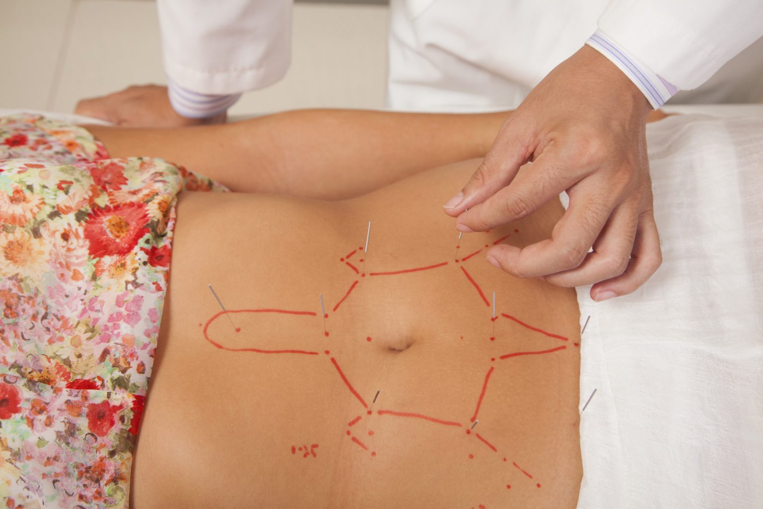 Acupuncture, a technique of traditional Chinese medicine (UmlimPhotos)